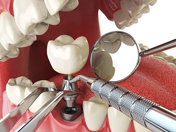 Best Emergency Dental Care for Broken or Chipped Teeth in Pascoag, RI